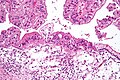 Profile Picture of Ovarian canceron Wikipedia