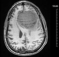 Profile Picture of Meningioma - Wikipediaon Wikipedia