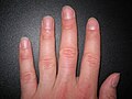 Profile Picture of Nail (anatomy)on Wikipedia