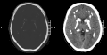 Profile Picture of Primary familial brain calcificationon Wikipedia