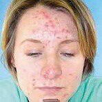 Profile Picture of Alison Frogenson (@pop_pimples) on Instagram