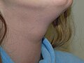 Profile Picture of Thyroglossal cyst - Wikipediaon Wikipedia