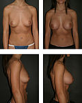 Profile Picture of Breast augmentation - Wikipediaon Wikipedia