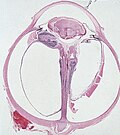 Profile Picture of Persistent fetal vasculatureon Wikipedia