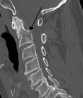 Profile Picture of Cervical fractureon Wikipedia