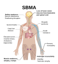 Profile Picture of Spinal and bulbar muscular atrophyon Wikipedia