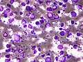 Profile Picture of B-cell lymphomaon Wikipedia