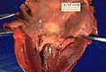 Profile Picture of Rheumatic feveron Wikipedia