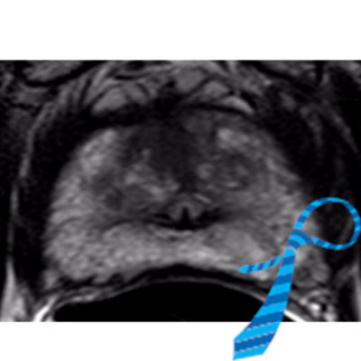 Profile Picture of SAR Prostate DFP (@SAR_ProstateDFP) on Twitter